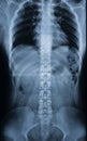 X-ray of a manÃ¢â¬â¢s body - spine, pelvic bones, ribs